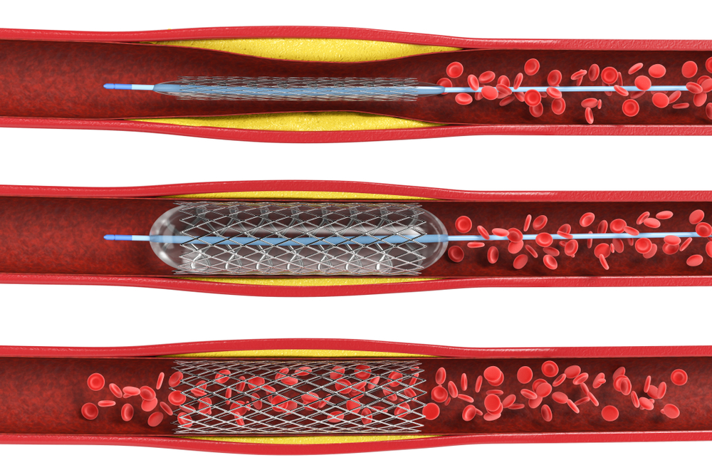 Stents et angioplastie : la vérité a du mal à passer !